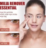 Smooth Milia Remover Serum (30ml) - Image 5