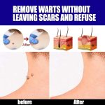 Warts Remover ointment - Image 3